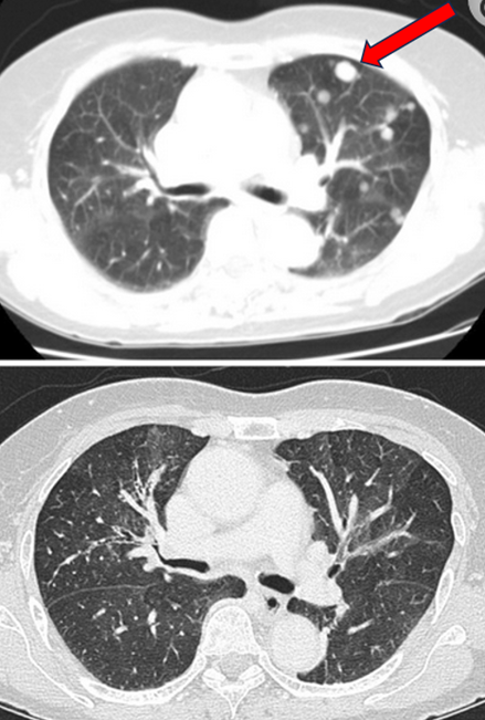 Multiple lung nodules disappeared after high-dose IV vitamin C treatments